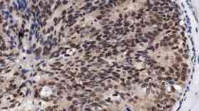 Fears breast cancer progress could stall due to backlog