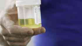 Cervical cancer self-tests deemed smear alternative