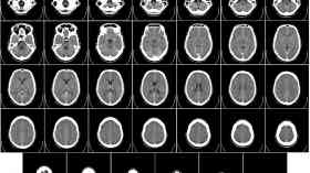 Dye to be used in initial surgery for brain tumours