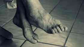 Arthritis drug could reduce dementia risk