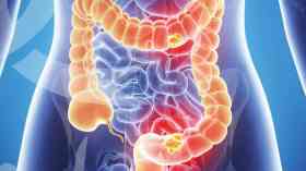 Genetic bowel cancer test failings revealed
