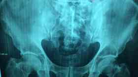 Health screening programmes 'not meeting targets'