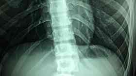 Halt to spinal operations at Cheshire hospital