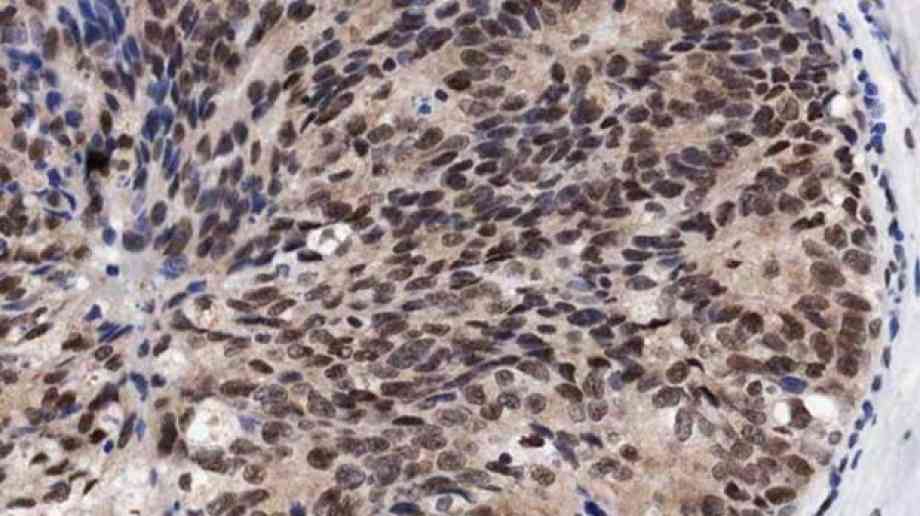 Fears breast cancer progress could stall due to backlog