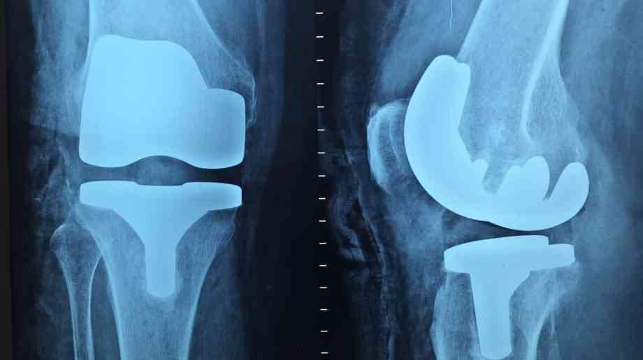 Hospital celebrates first robot-guided knee surgery