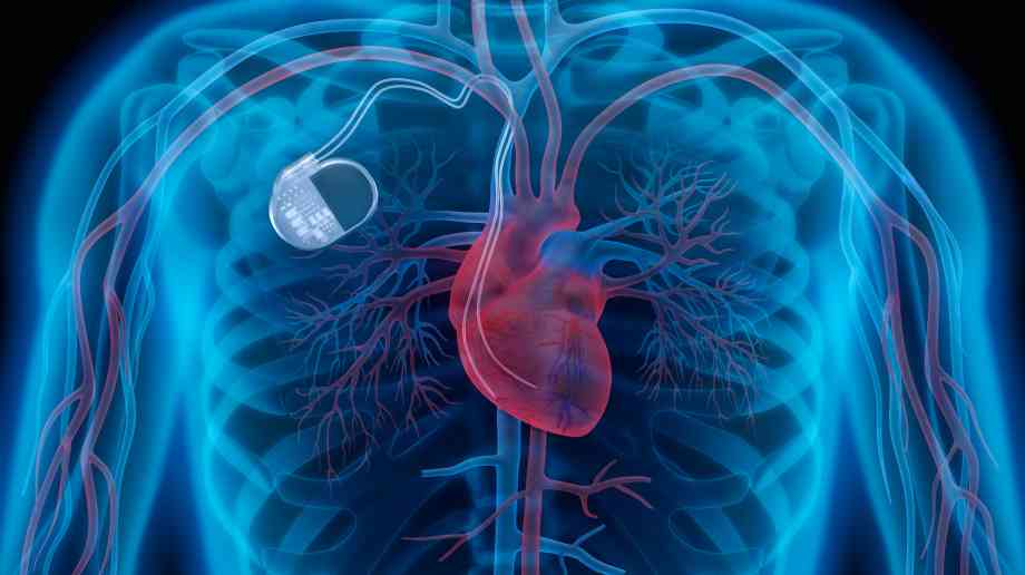 UK’s first artificial heart pump due to trial in 2018