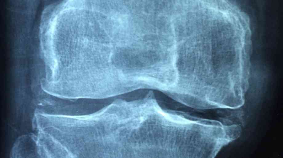 Partial knee replacement could save the NHS £30m