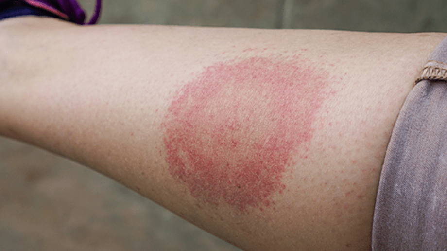 Lyme Disease Lyme Disease